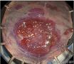内镜下粘膜切除治疗结肠早期神经内分泌癌一例（转帖）图1