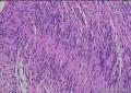 经典病例:神经鞘瘤图8