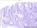 直肠癌术后降结肠新生物图4