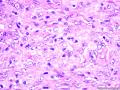 右小腿腓肠肌肿块{镜下见上皮样细胞和多核巨细胞及含铁血黄色）图9
