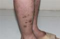 双小腿红斑结节伴痛反复发作5年图2