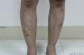 双小腿红斑结节伴痛反复发作5年图1