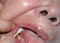 舌部肿物穿刺，是瘤细胞吗？图1