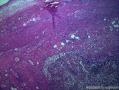 阑尾  神经内分泌肿瘤？急性蜂窝织炎性阑尾炎。图2