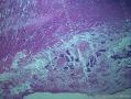 阑尾  神经内分泌肿瘤？急性蜂窝织炎性阑尾炎。图4
