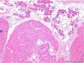 腮腺肿块：嗜酸细胞结节性增生 or 嗜酸细胞腺瘤 or 其它？图4