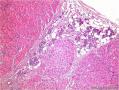腮腺肿块：嗜酸细胞结节性增生 or 嗜酸细胞腺瘤 or 其它？图3