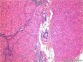 腮腺肿块：嗜酸细胞结节性增生 or 嗜酸细胞腺瘤 or 其它？图1