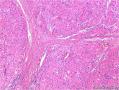 腮腺肿块：嗜酸细胞结节性增生 or 嗜酸细胞腺瘤 or 其它？图5