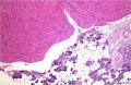 腮腺肿块：嗜酸细胞结节性增生 or 嗜酸细胞腺瘤 or 其它？图2