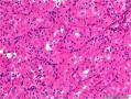 腮腺肿块：嗜酸细胞结节性增生 or 嗜酸细胞腺瘤 or 其它？图7