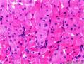 腮腺肿块：嗜酸细胞结节性增生 or 嗜酸细胞腺瘤 or 其它？图8