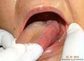 舌根肿物穿刺，是鳞癌吗？图2