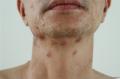 面颈躯干多发大小不等痛性红色丘疹结节1年图5