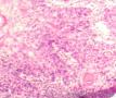 淋巴结转移性高中分化鳞癌  伴周围组织浸润图5