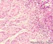 淋巴结转移性高中分化鳞癌  伴周围组织浸润图4