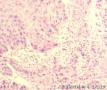 淋巴结转移性高中分化鳞癌  伴周围组织浸润图1