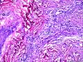 报皮下纤维组织瘤样增生是否合适？图16
