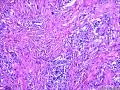 报皮下纤维组织瘤样增生是否合适？图15