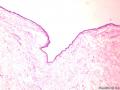 乳腺囊性肿物图2
