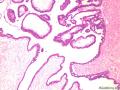 乳腺囊性肿物图3