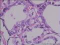 甲状腺够癌么图13