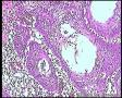 宫颈上皮下小巢片状上皮组织图11