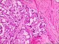 浸润性导管癌，小叶癌化图8