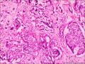 浸润性导管癌，小叶癌化图9