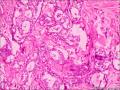 浸润性导管癌，小叶癌化图13