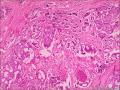浸润性导管癌，小叶癌化图2