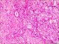 浸润性导管癌，小叶癌化图16