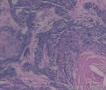 基底细胞癌可以伴有鳞状细胞癌吗？图15