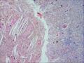 乳腺导管内乳头状瘤，部分区域呈非典型增生图13