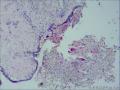 乳腺导管内乳头状瘤，部分区域呈非典型增生图14