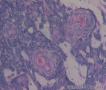 基底细胞癌可以伴有鳞状细胞癌吗？图13