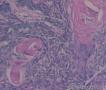 基底细胞癌可以伴有鳞状细胞癌吗？图14