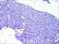 乳腺导管内乳头状瘤，部分区域呈非典型增生图11