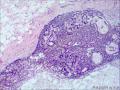 乳腺导管内乳头状瘤，部分区域呈非典型增生图3