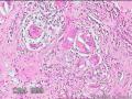 臀部脓肿（见多核巨噬细胞）图6