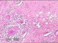 臀部脓肿（见多核巨噬细胞）图8