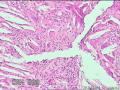 臀部脓肿（见多核巨噬细胞）图14