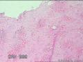 臀部脓肿（见多核巨噬细胞）图1