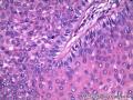 额部肿物：脂溢性角化病？基底细胞癌？图16