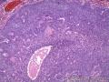 额部肿物：脂溢性角化病？基底细胞癌？图11