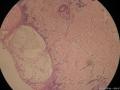 小草典型病例之五：新生儿四肢红斑水疱图7