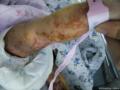 小草典型病例之五：新生儿四肢红斑水疱图4