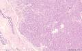乳腺分泌性癌图3