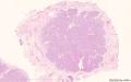乳腺分泌性癌图1