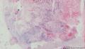 睾丸肿物  精原细胞瘤 、图1